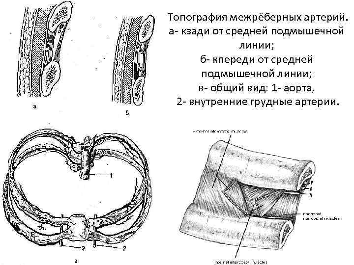 Топография межрёберных артерий. а- кзади от средней подмышечной линии; б- кпереди от средней подмышечной