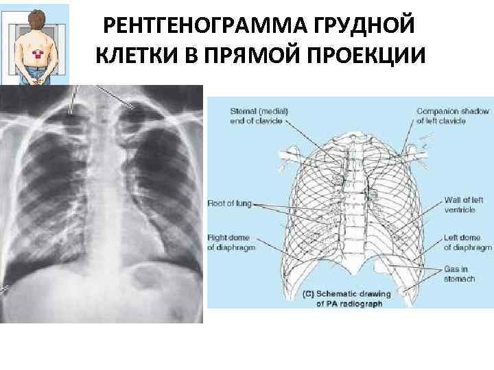РЕНТГЕНОГРАММА ГРУДНОЙ КЛЕТКИ В ПРЯМОЙ ПРОЕКЦИИ 