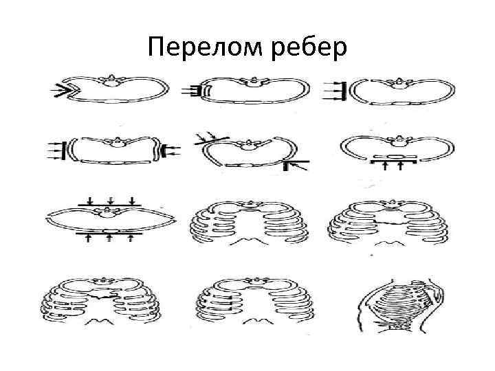 Перелом ребер 