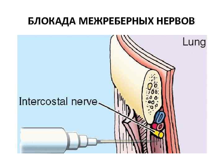 БЛОКАДА МЕЖРЕБЕРНЫХ НЕРВОВ 