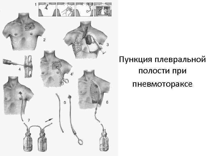 Спонтанный пневмоторакс карта смп