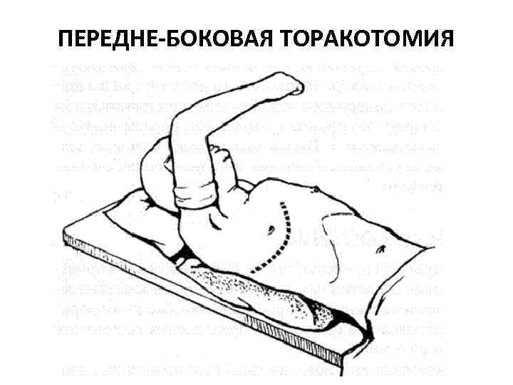 ПЕРЕДНЕ-БОКОВАЯ ТОРАКОТОМИЯ 