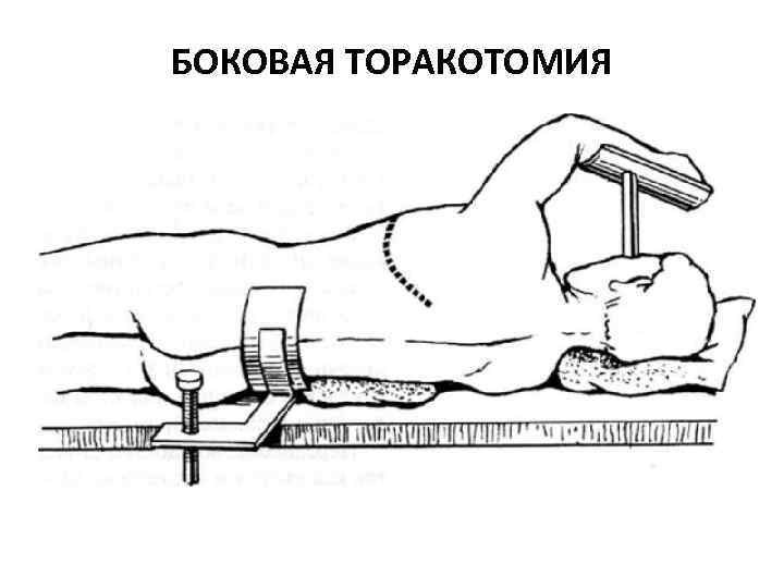 БОКОВАЯ ТОРАКОТОМИЯ 