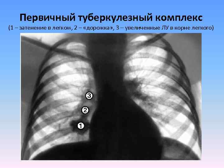 Первичный туберкулезный комплекс (1 – затенение в легком, 2 – «дорожка» , 3 –