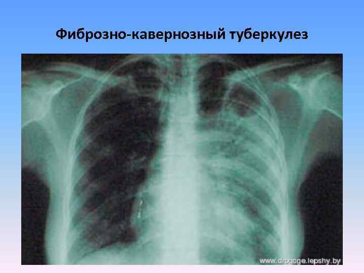 Фиброзно-кавернозный туберкулез 