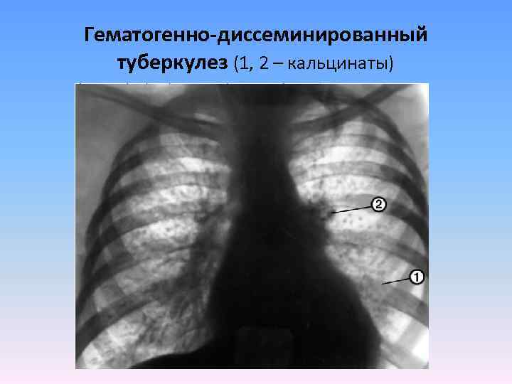 Острый диссеминированный туберкулез. Гематогенно диссеминированный туберкулез рентген. Острый диссеминированный туберкулез рентген. Хронический гематогенно диссеминированный туберкулез. Острый гематогенно-диссеминированный туберкулез.