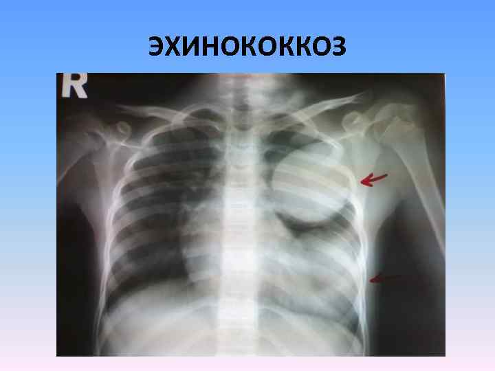 ЭХИНОКОККОЗ 