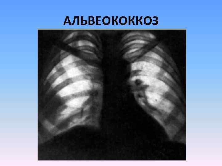 АЛЬВЕОКОККОЗ 