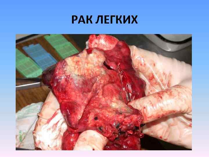РАК ЛЕГКИХ 