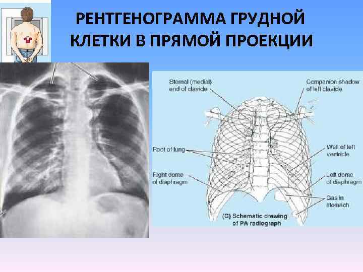 Схема описания рентгенограммы грудной клетки