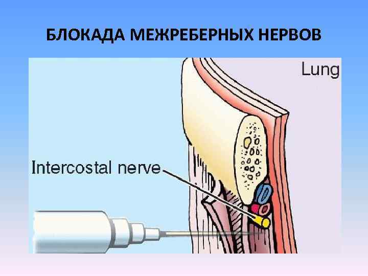 БЛОКАДА МЕЖРЕБЕРНЫХ НЕРВОВ 