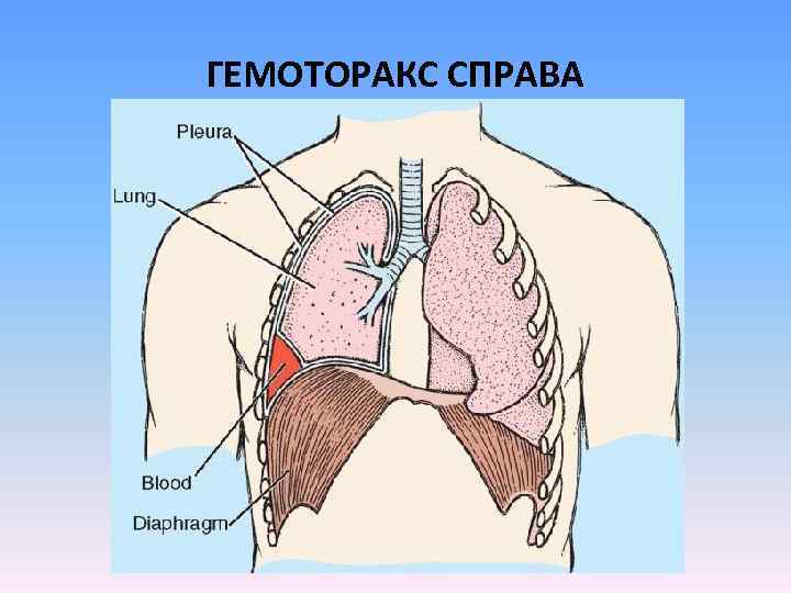 Гемоторакс клиническая картина