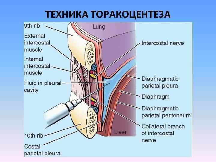 ТЕХНИКА ТОРАКОЦЕНТЕЗА 
