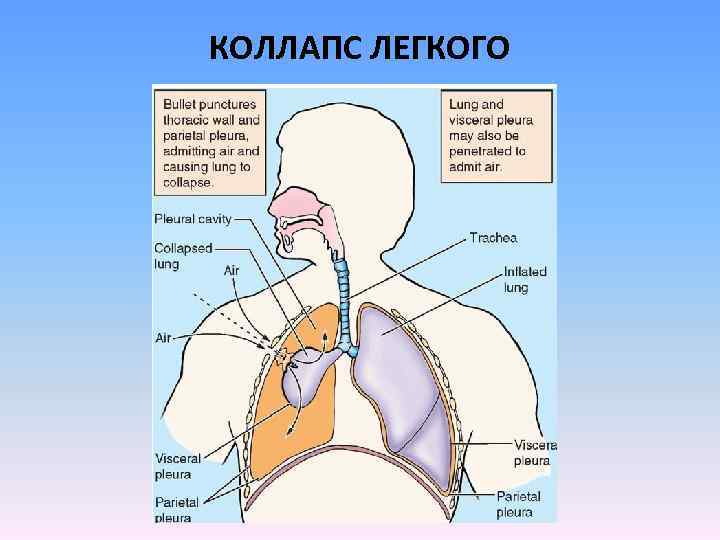 Коллапс легкого это. Коллапс легкого. Частичный коллапс легкого. Коллапс левого легкого. Коллапс правого легкого.