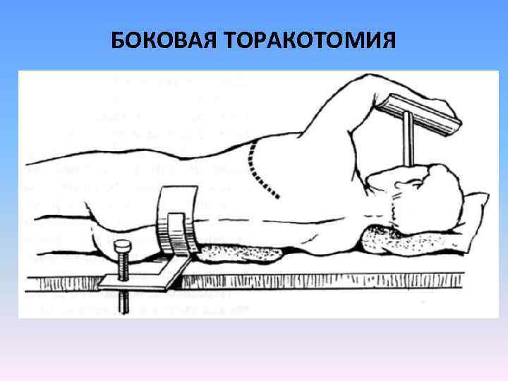 БОКОВАЯ ТОРАКОТОМИЯ 