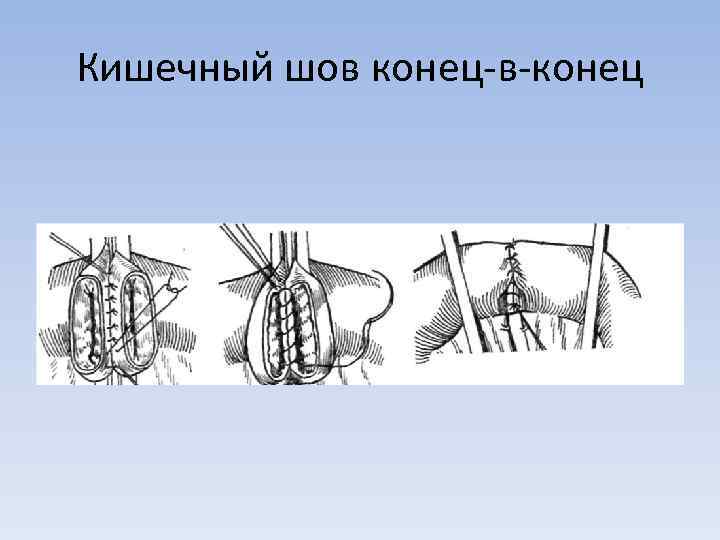 Кишечные швы топографическая анатомия