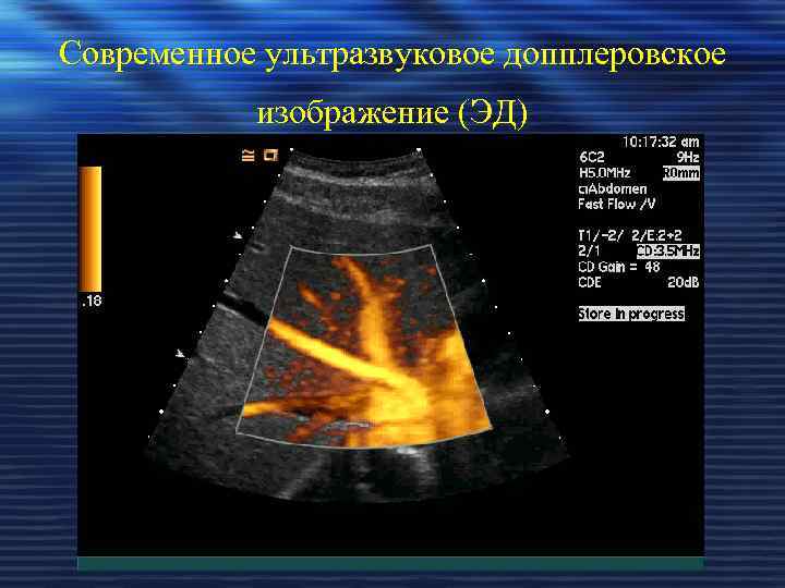 Современное ультразвуковое допплеровское изображение (ЭД) 