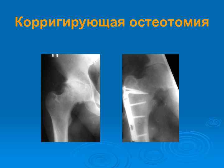 Корригирующая остеотомия 