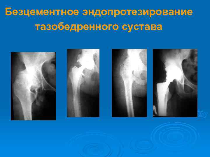 Безцементное эндопротезирование тазобедренного сустава 