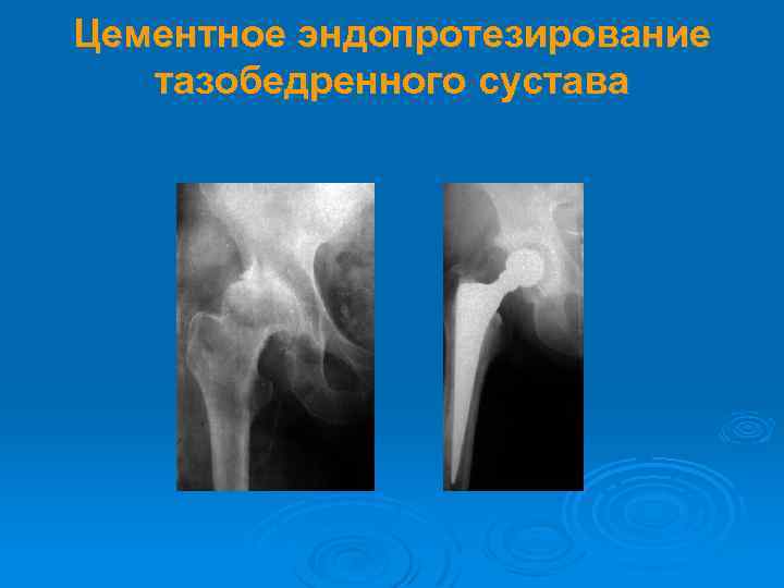 Цементное эндопротезирование тазобедренного сустава 