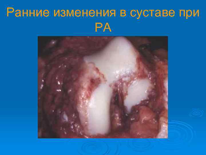 Ранние изменения в суставе при РА 