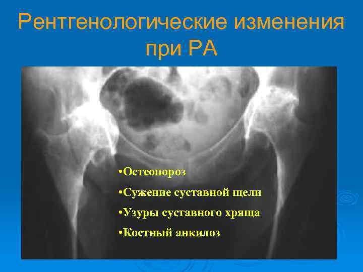 Рентгенологические изменения при РА • Остеопороз • Сужение суставной щели • Узуры суставного хряща