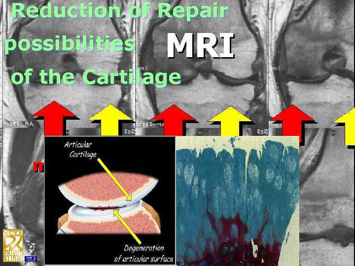 Reduction of Repair possibilities of the Cartilage 