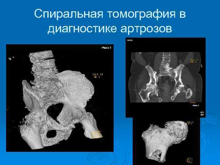 Спиральная томография в диагностике артрозов 