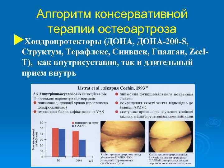 Алгоритм консервативной терапии остеоартроза u. Хондропротекторы (ДОНА, ДОНА-200 -S, Структум, Терафлекс, Синвиск, Гиалган, Zeel.