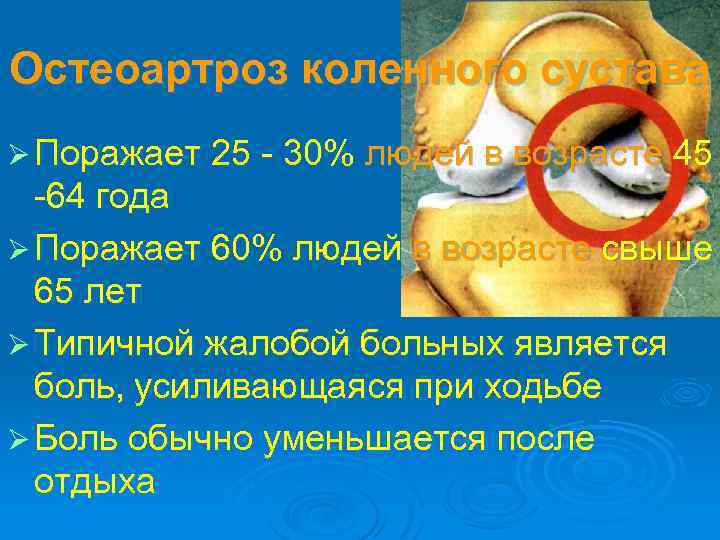 Остеоартроз коленного сустава Ø Поражает 25 - 30% людей в возрасте 45 -64 года