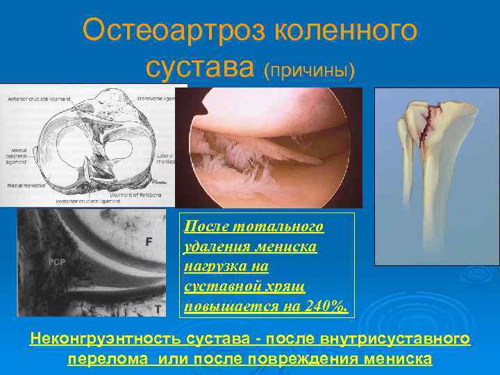 Остеоартроз коленного сустава (причины) После тотального удаления мениска нагрузка на суставной хрящ повышается на