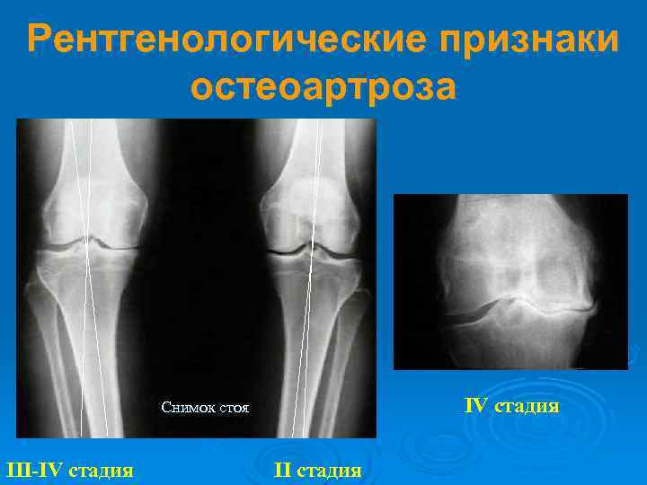 Рентгенологические признаки остеоартроза IV стадия Снимок стоя III-IV стадия II стадия 