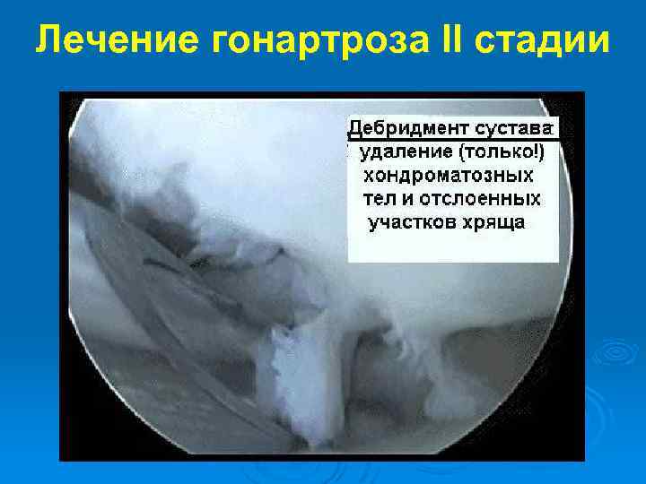 Лечение гонартроза II стадии 