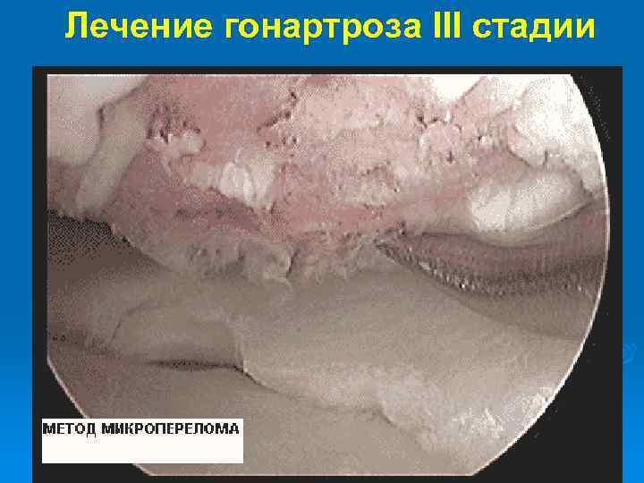 Лечение гонартроза III стадии 