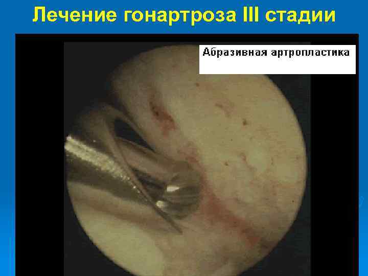 Лечение гонартроза III стадии 