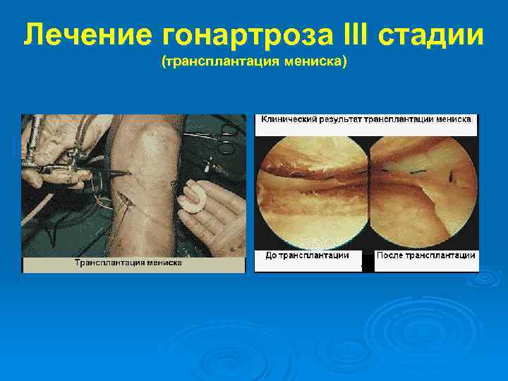 Лечение гонартроза III стадии (трансплантация мениска) 