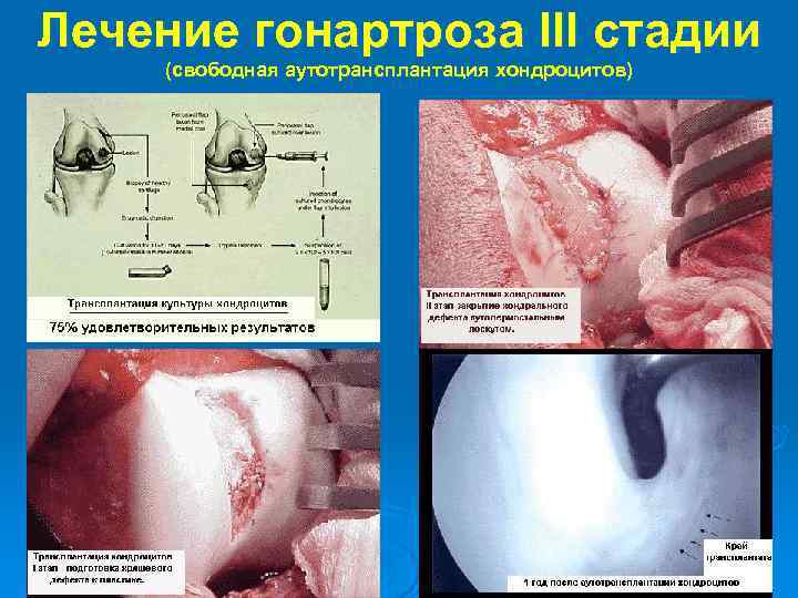 Лечение гонартроза III стадии (свободная аутотрансплантация хондроцитов) 