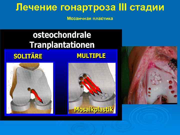 Лечение гонартроза III стадии Мозаичная пластика 