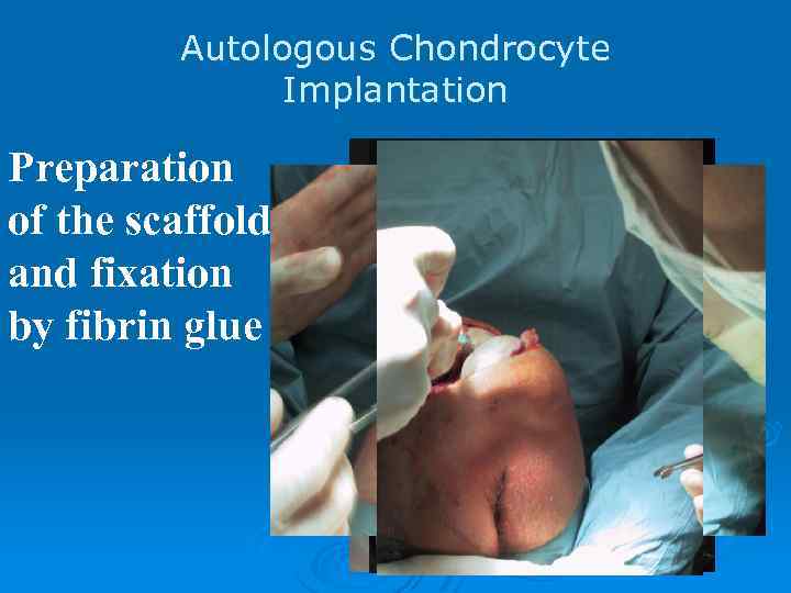 Autologous Chondrocyte Implantation Preparation of the scaffold and fixation by fibrin glue 