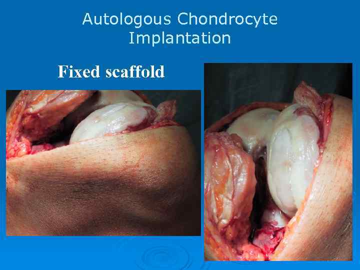 Autologous Chondrocyte Implantation Fixed scaffold 