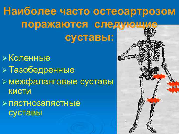 Наиболее часто остеоартрозом поражаются следующие суставы: Ø Коленные Ø Тазобедренные Ø межфаланговые суставы кисти