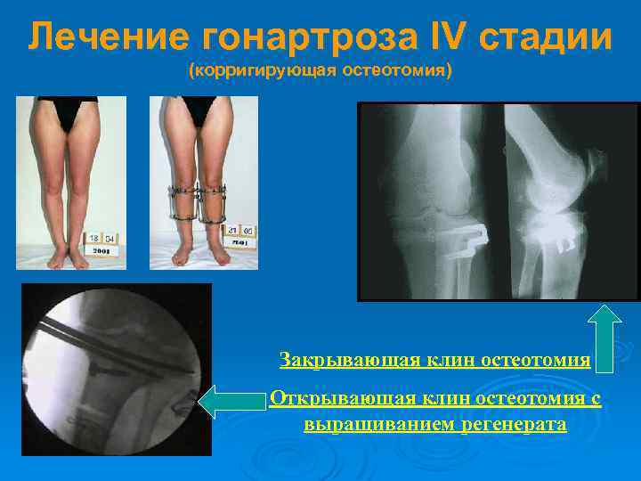 Лечение гонартроза IV стадии (корригирующая остеотомия) Закрывающая клин остеотомия Открывающая клин остеотомия с выращиванием