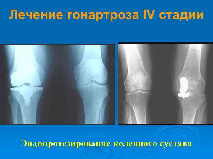 Гонартроз коленного сустава 1. Гонартроз 2 стадии рентген. Гонартроз 2 степени по Kellgren Lawrence. Деформирующий гонартроз 4 степени.