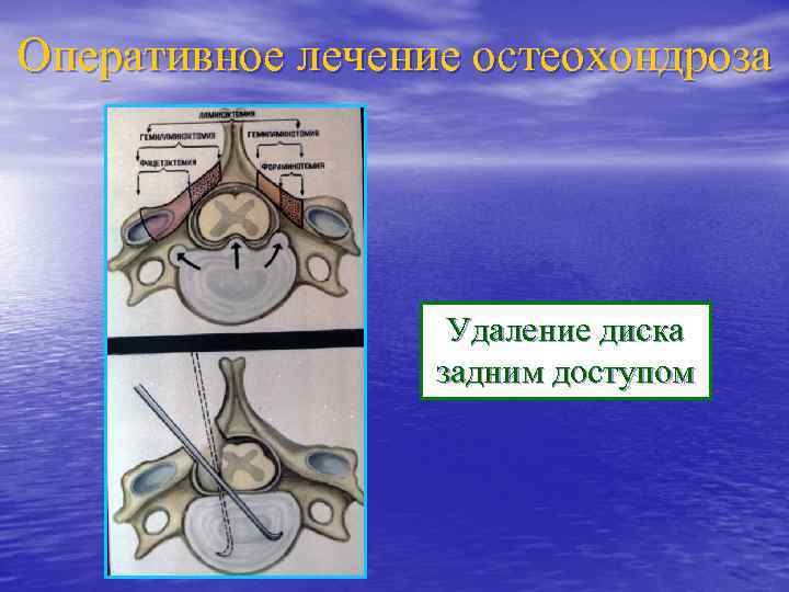 Оперативное лечение остеохондроза Удаление диска задним доступом 