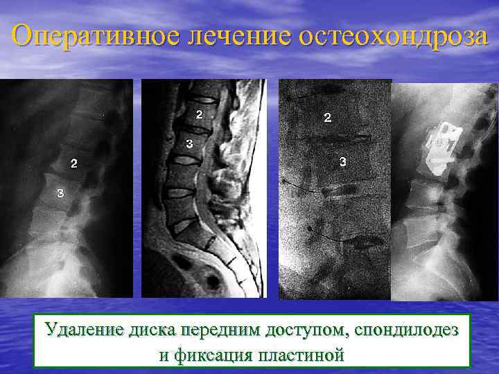 Оперативное лечение остеохондроза Удаление диска передним доступом, спондилодез и фиксация пластиной 