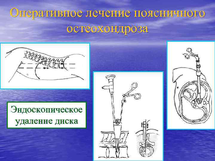 Оперативное лечение поясничного остеохондроза Эндоскопическое удаление диска 