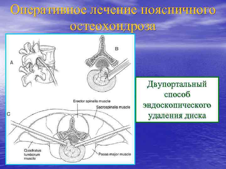 Оперативное лечение поясничного остеохондроза Двупортальный способ эндоскопического удаления диска 