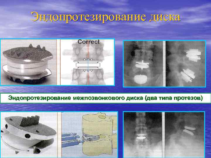 Эндопротезирование диска Эндопротезирование межпозвонкового диска (два типа протезов) 