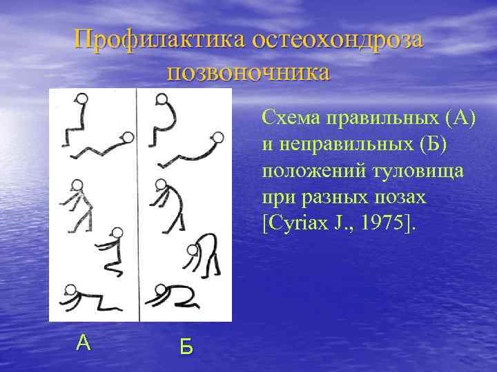 Профилактика остеохондроза позвоночника Схема правильных (А) и неправильных (Б) положений туловища при разных позах