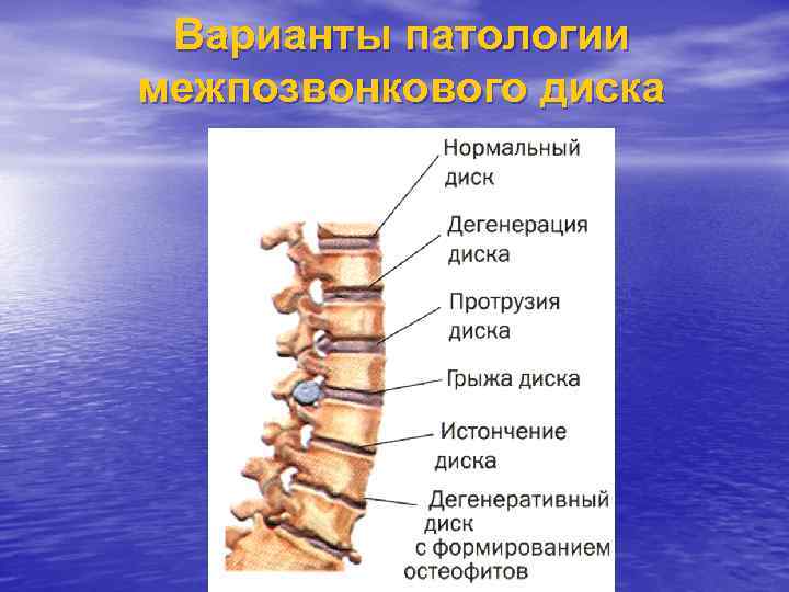 Варианты патологии межпозвонкового диска 